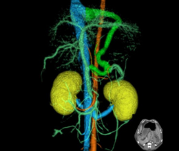 先天性門脈シャント CT画像